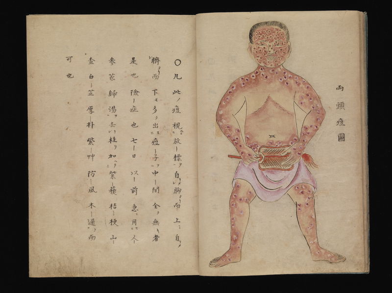 Smallpox_illustration__Japanese_manuscript__c._1720_Wellcome_L0074716