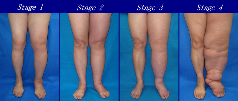 Lower_Limb_Lymphedema