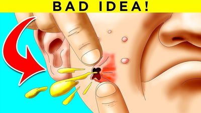 Why Popping Pimples is a Really Bad Idea! Fact Show 19