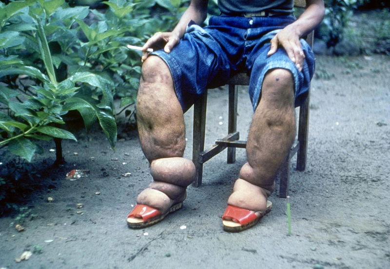 lymphatic filariasis or elephantiasis