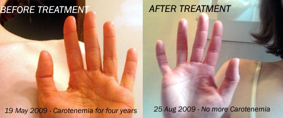 Carotenemia Before and After treatment