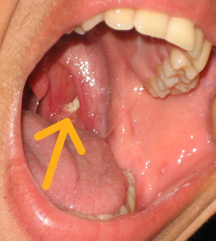 Tonsil stone